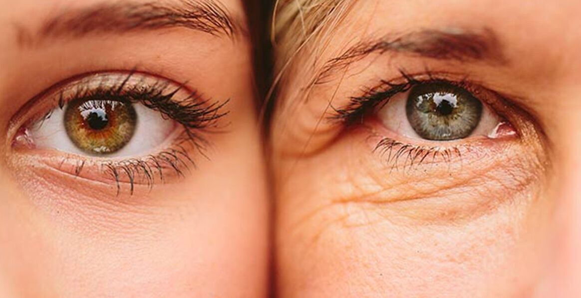 Внешние признаки старения кожи вокруг глаз у двух женщин разных возрастов