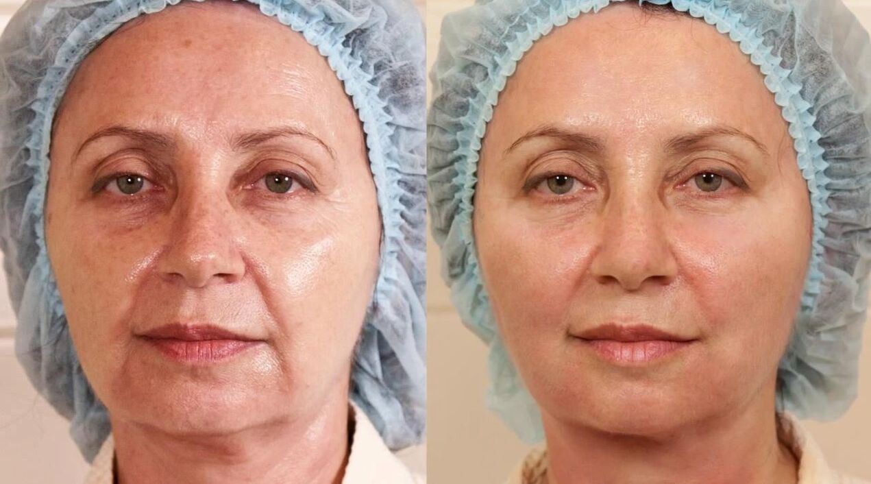 фото до и после подтяжки кожи лица